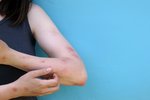 Diagnosed with monkeypox in Iceland – A cause for concern says Chief Epidemiologist