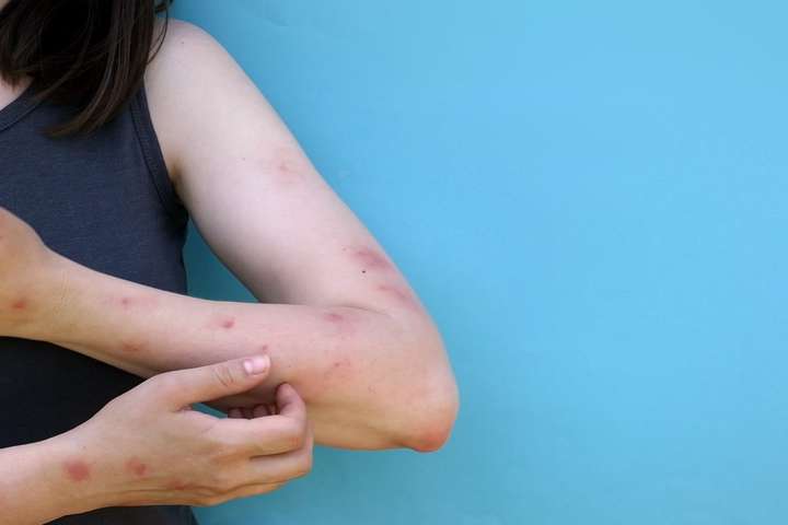 Third case of Monkeypox diagnosed in Iceland