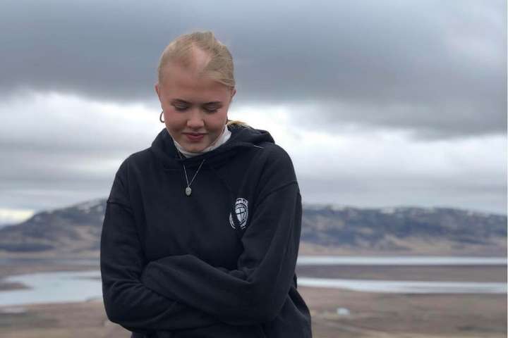 Signý gæti misst allt hárið: „Hugsa stundum hvort fólki finnist þetta vera ógeðslegt“